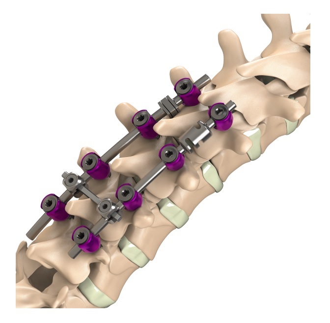 Система для транспедикулярної фіксації хребта Aditus Medical GmbH